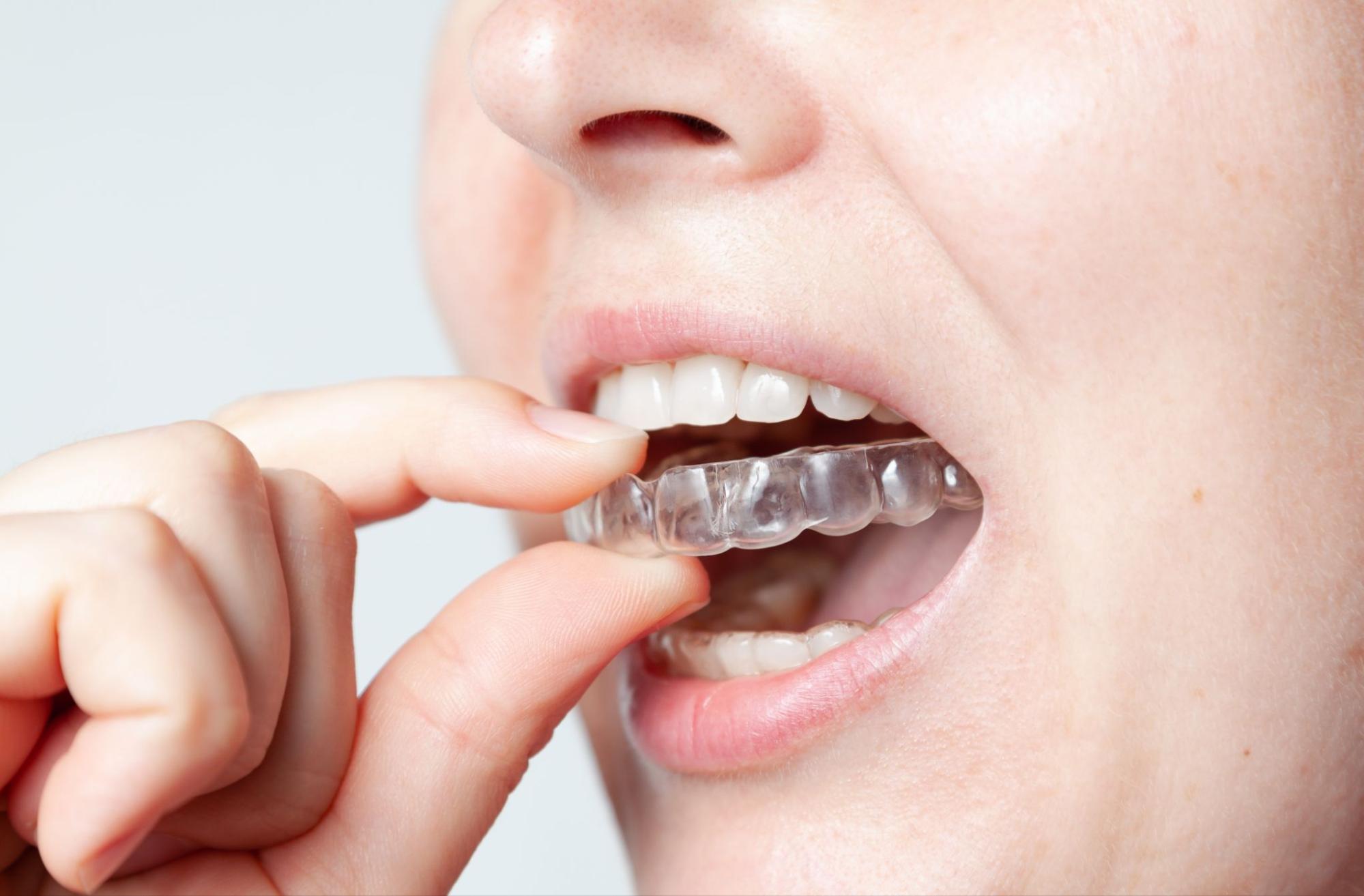 How Long Do I Need to Wear a Retainer After Braces?